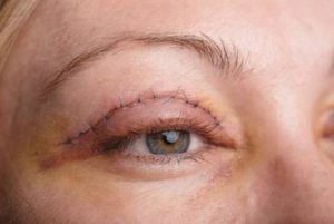 blepharoplastie-postop